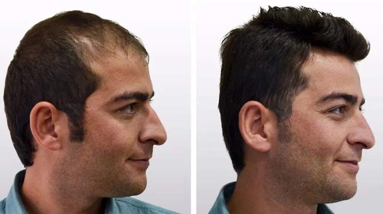 Hair Transplant
